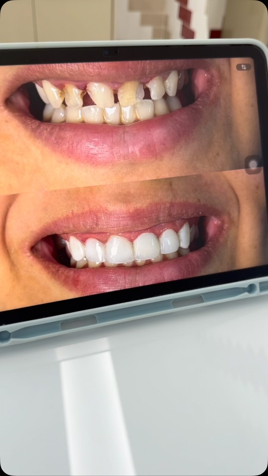 Planejamento de facetas mostrado ao paciente