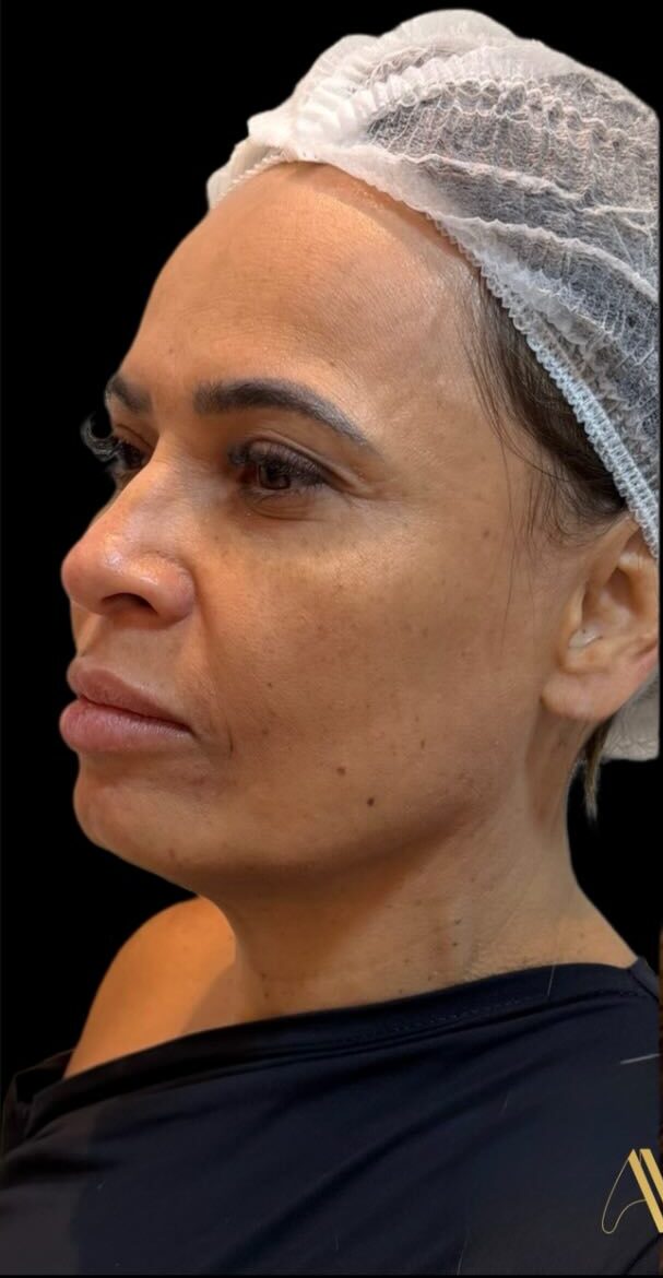Antes da harmonização full face