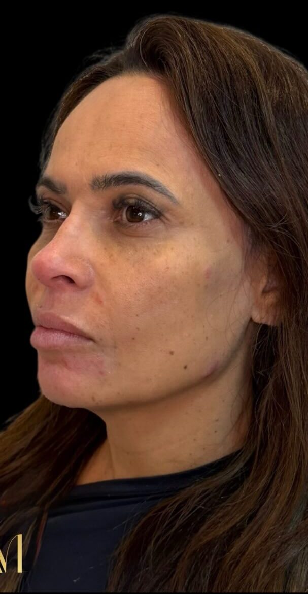 Depois da harmonização full face