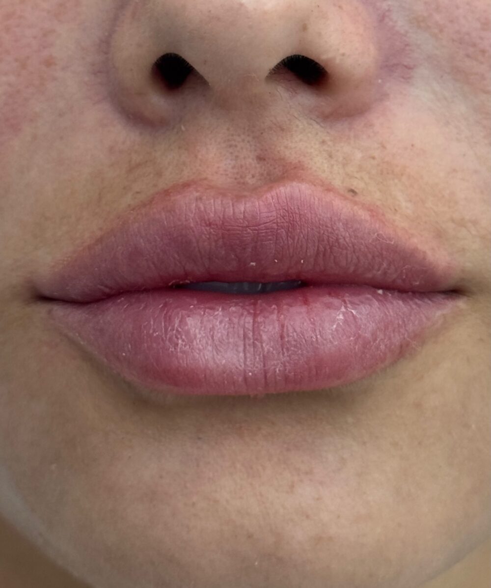 Resultado de preenchimento labial