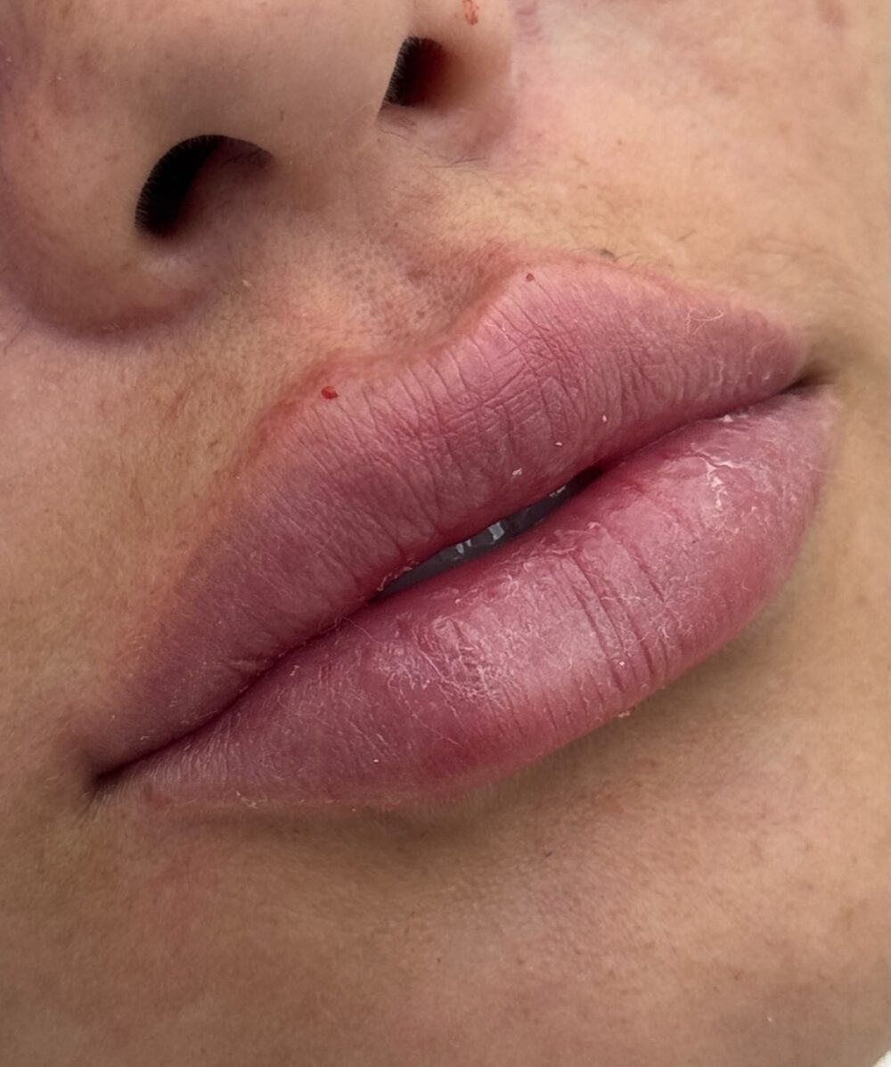 Resultado de preenchimento labial