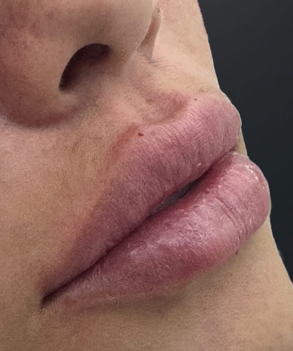 Resultado de preenchimento labial