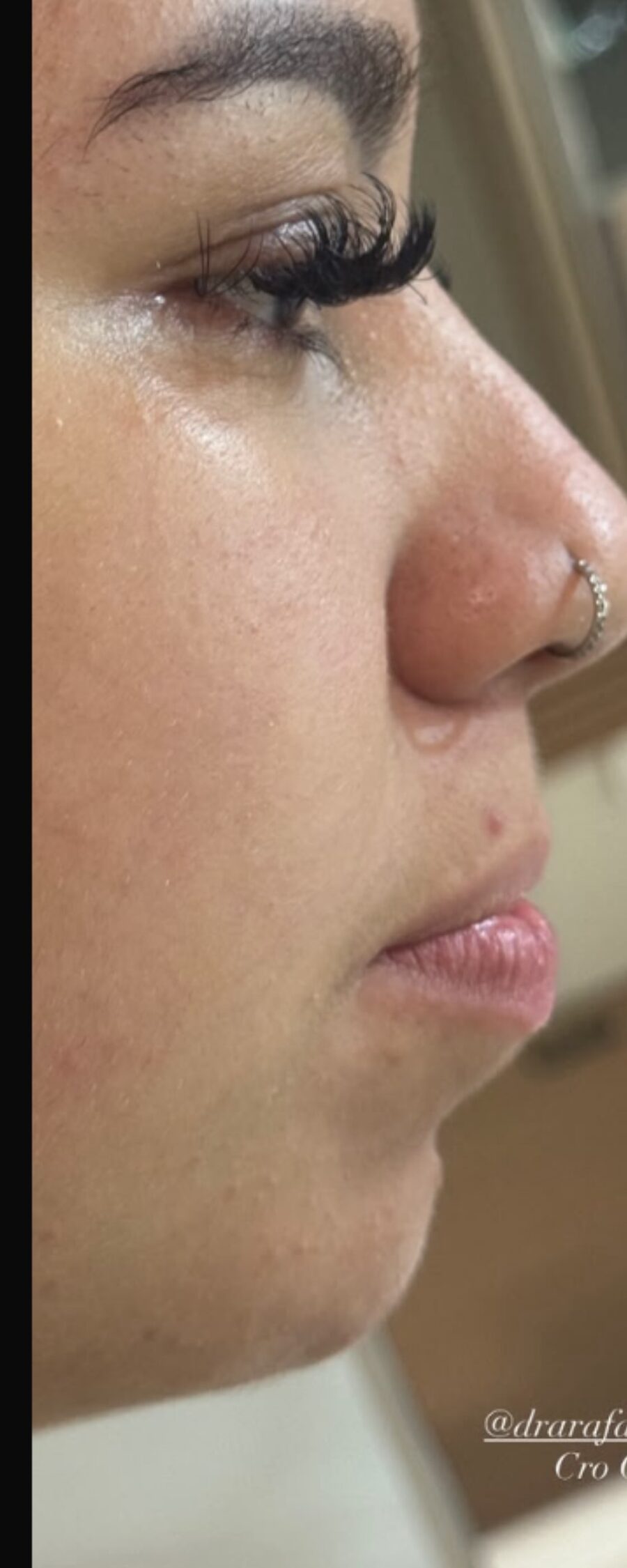 Perfil antes da perfiloplastia