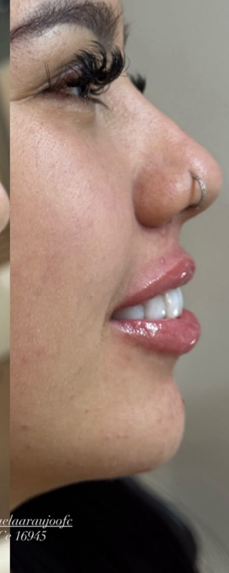 Perfil depois da perfiloplastia