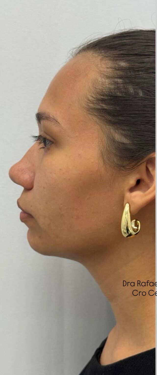 Perfil antes do preenchimento de mento