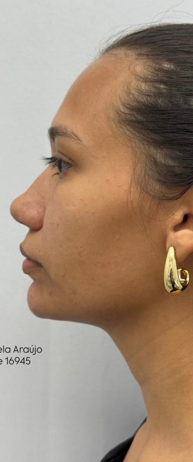 Perfil depois do preenchimento de mento