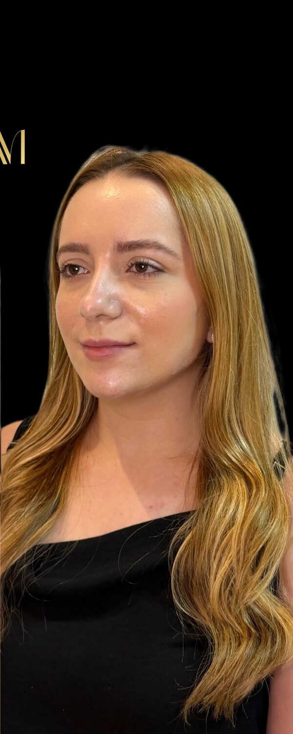 Depois da sustentação facial